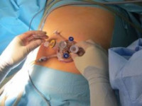Chirurgia prin incizie unică – 0 cicatrici, multiple beneficii