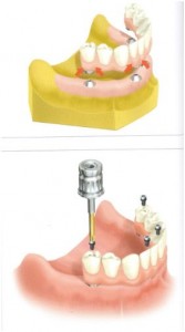 implantology ALL ON 4