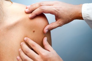 dermatologie alunite cancer piele