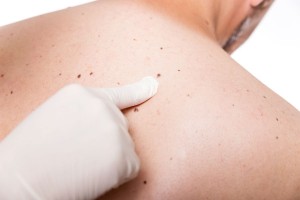 alunite cancer dermatologie